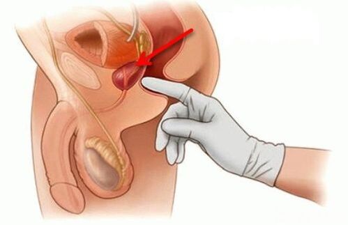 masáž prostaty pro prostatitidu